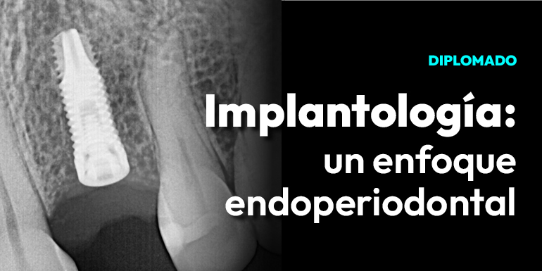 Implantología: Un Enfoque Endoperiodontal